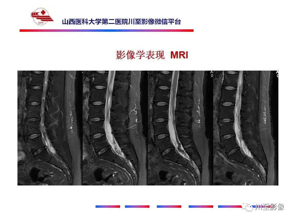 影像PPT - 【PPT】椎管内畸胎瘤-8 影像PPT - 【PPT】椎管内畸胎瘤-8