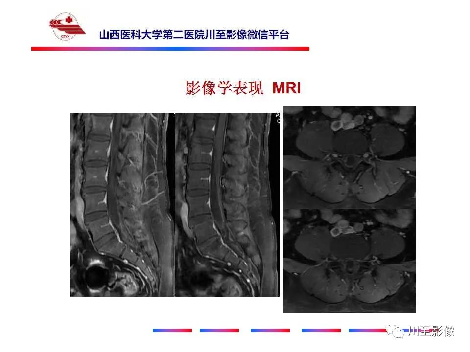 影像PPT - 【PPT】椎管内畸胎瘤-9 影像PPT - 【PPT】椎管内畸胎瘤-9