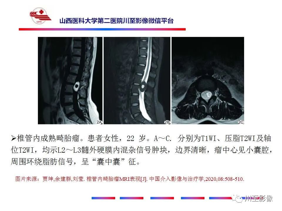 影像PPT - 【PPT】椎管内畸胎瘤-22 影像PPT - 【PPT】椎管内畸胎瘤-22