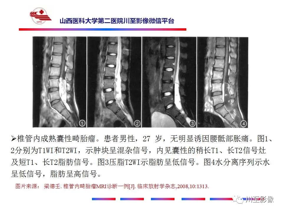 影像PPT - 【PPT】椎管内畸胎瘤-23 影像PPT - 【PPT】椎管内畸胎瘤-23