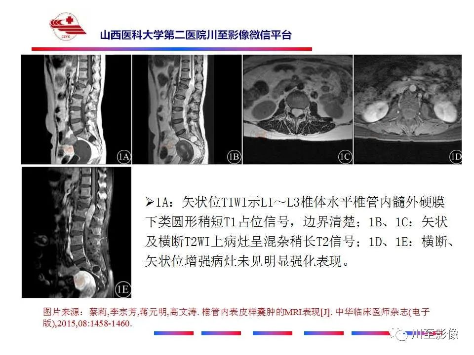 影像PPT - 【PPT】椎管内畸胎瘤-25 影像PPT - 【PPT】椎管内畸胎瘤-25