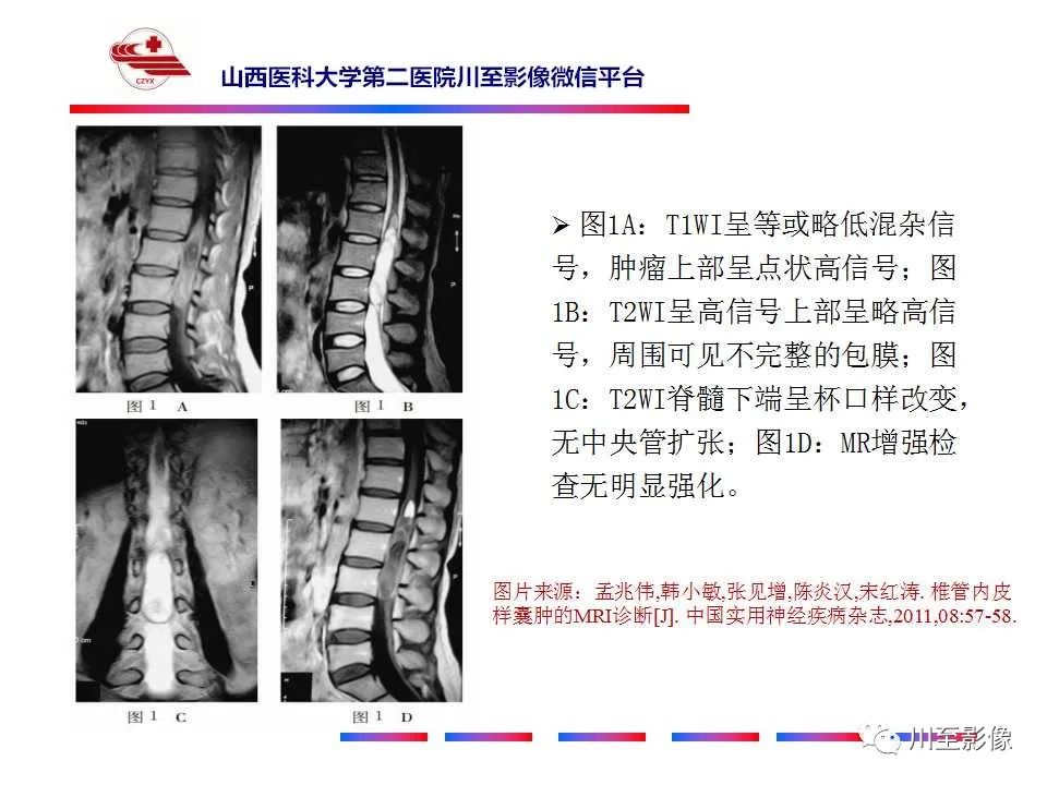 影像PPT - 【PPT】椎管内畸胎瘤-27 影像PPT - 【PPT】椎管内畸胎瘤-27