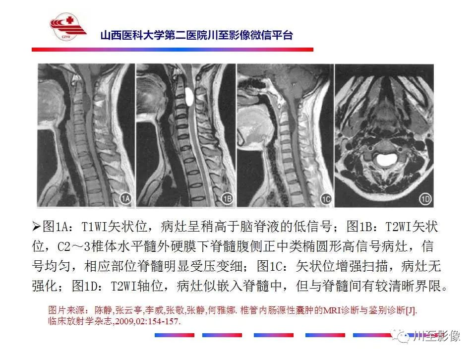 影像PPT - 【PPT】椎管内畸胎瘤-29 影像PPT - 【PPT】椎管内畸胎瘤-29