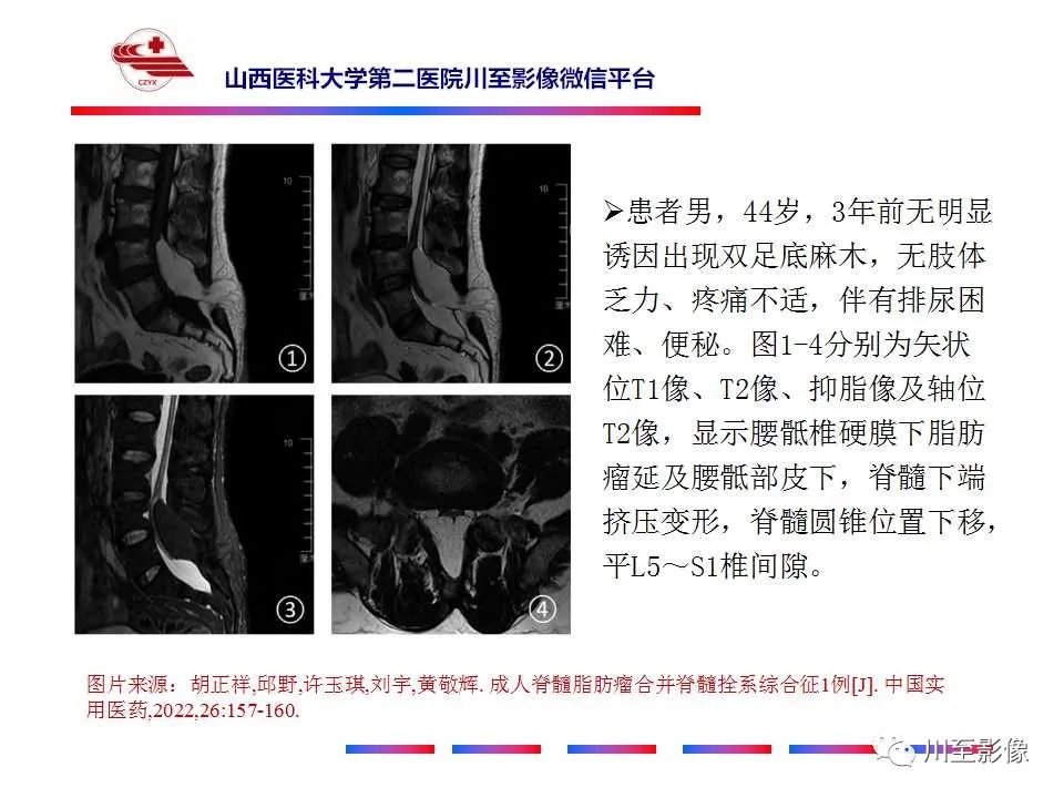 影像PPT - 【PPT】椎管内畸胎瘤-31 影像PPT - 【PPT】椎管内畸胎瘤-31