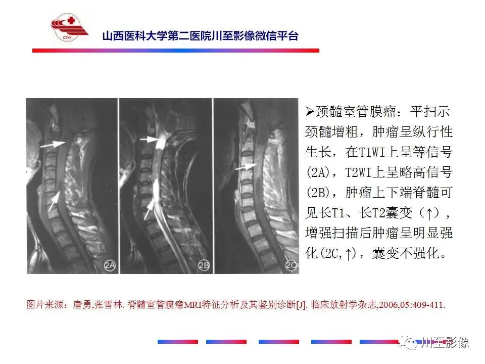 影像PPT - 【PPT】椎管内畸胎瘤-33 影像PPT - 【PPT】椎管内畸胎瘤-33