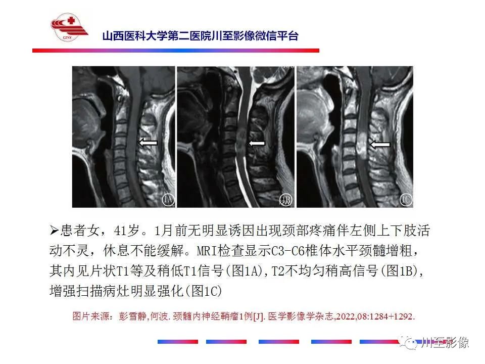 影像PPT - 【PPT】椎管内畸胎瘤-35 影像PPT - 【PPT】椎管内畸胎瘤-35