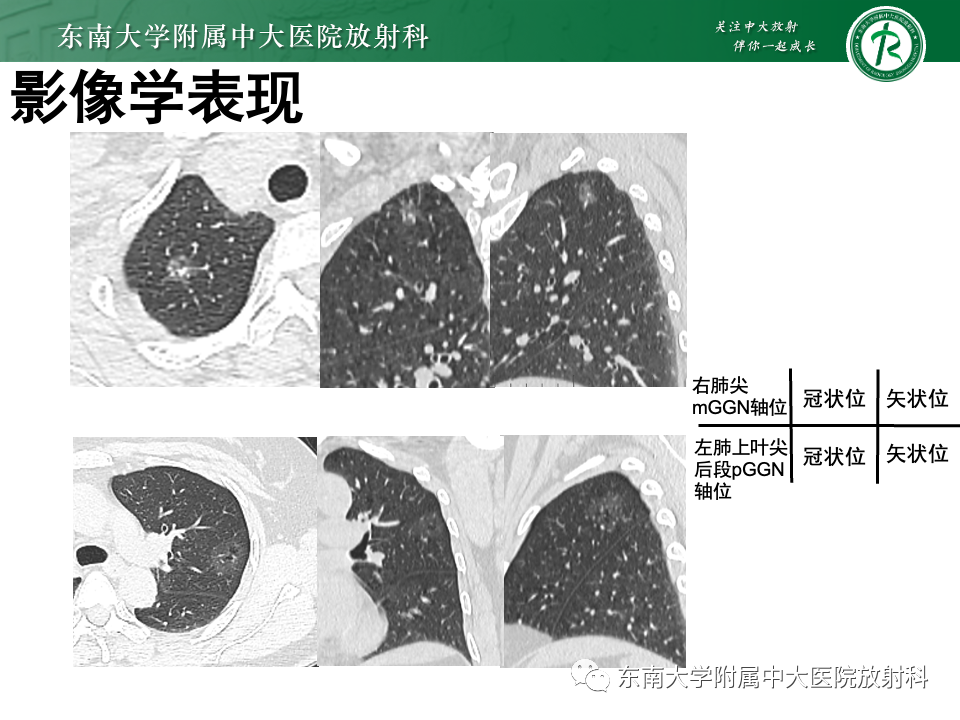 影像PPT - 【PPT】肺腺癌的CT影像表现-4 影像PPT - 【PPT】肺腺癌的CT影像表现-4