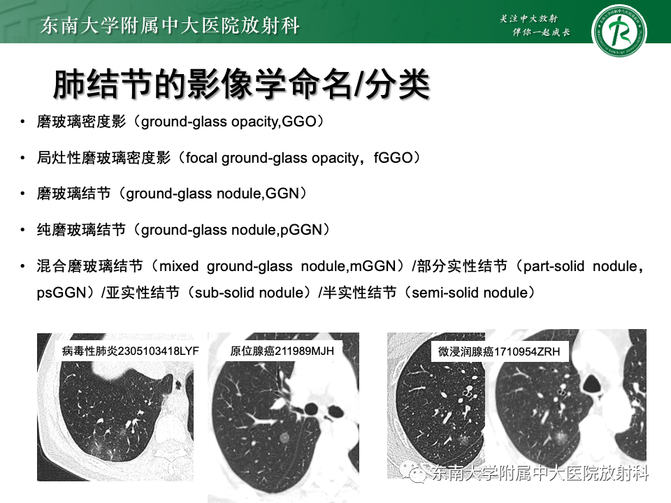 影像PPT - 【PPT】肺腺癌的CT影像表现-13 影像PPT - 【PPT】肺腺癌的CT影像表现-13