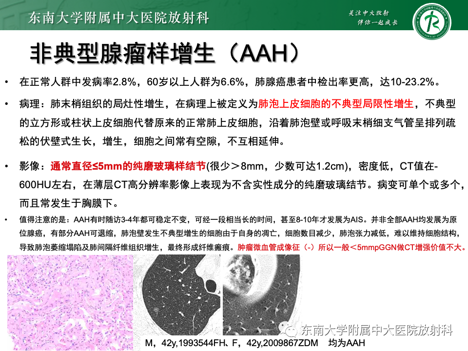 影像PPT - 【PPT】肺腺癌的CT影像表现-14 影像PPT - 【PPT】肺腺癌的CT影像表现-14