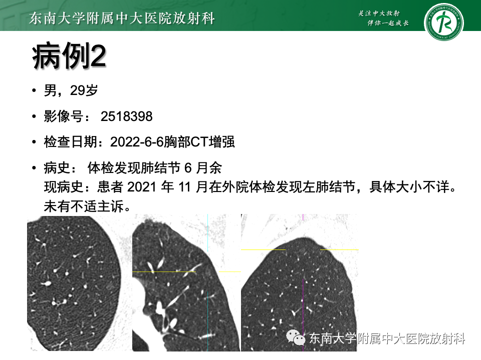 影像PPT - 【PPT】肺腺癌的CT影像表现-15 影像PPT - 【PPT】肺腺癌的CT影像表现-15