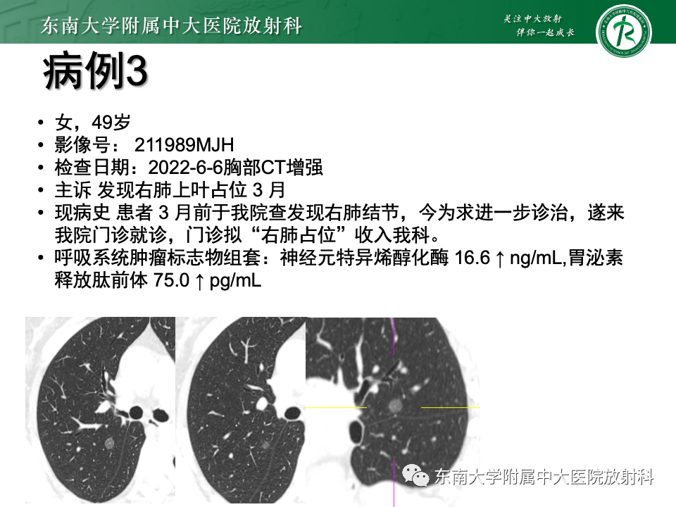 影像PPT - 【PPT】肺腺癌的CT影像表现-18 影像PPT - 【PPT】肺腺癌的CT影像表现-18