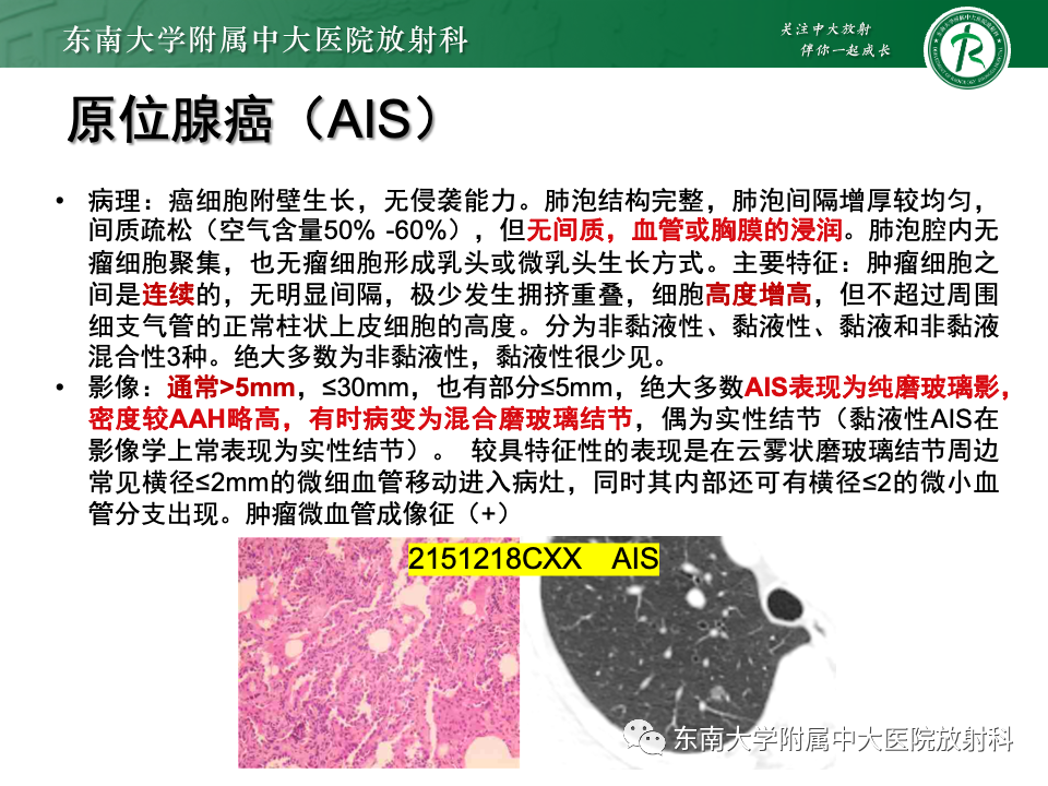 影像PPT - 【PPT】肺腺癌的CT影像表现-17 影像PPT - 【PPT】肺腺癌的CT影像表现-17