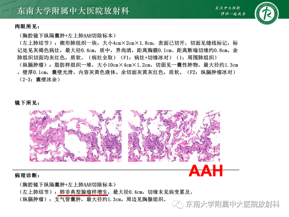 影像PPT - 【PPT】肺腺癌的CT影像表现-16 影像PPT - 【PPT】肺腺癌的CT影像表现-16