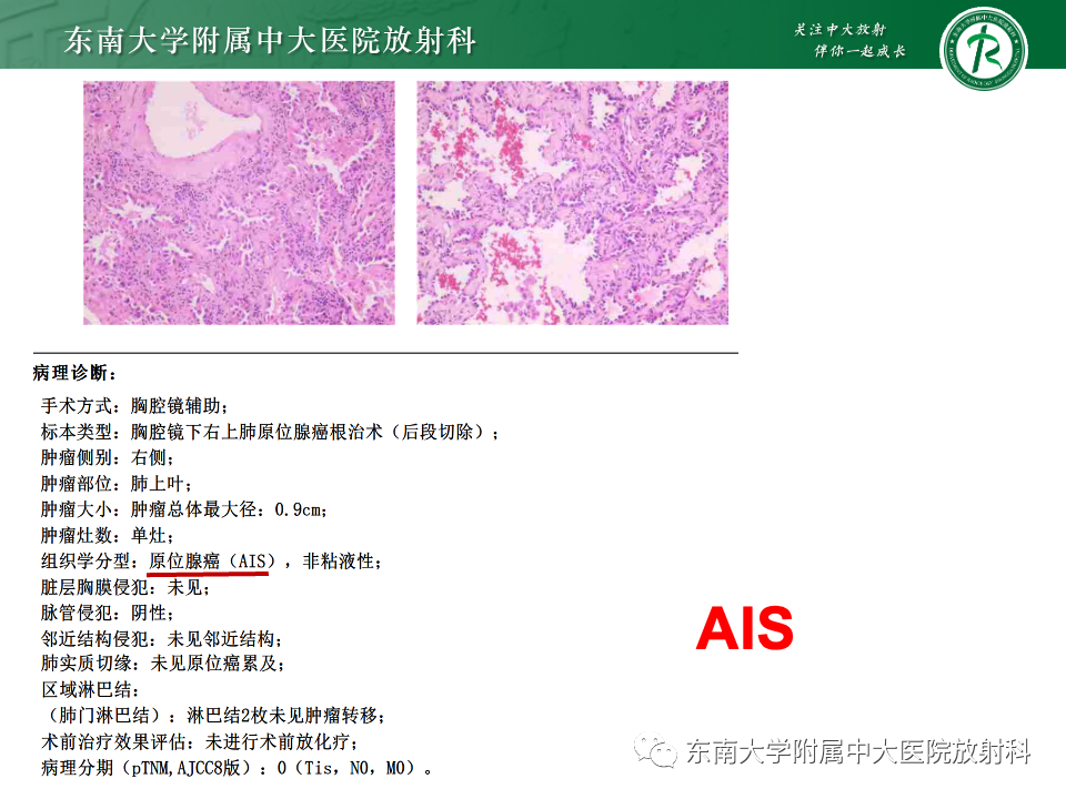 影像PPT - 【PPT】肺腺癌的CT影像表现-19 影像PPT - 【PPT】肺腺癌的CT影像表现-19