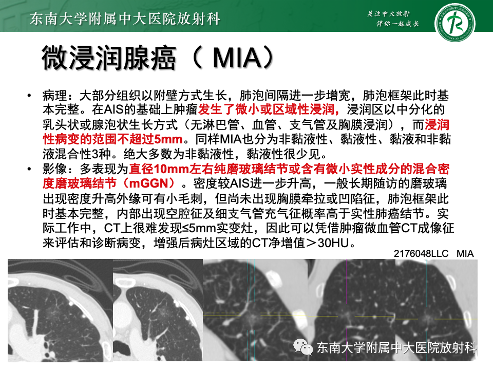影像PPT - 【PPT】肺腺癌的CT影像表现-20 影像PPT - 【PPT】肺腺癌的CT影像表现-20
