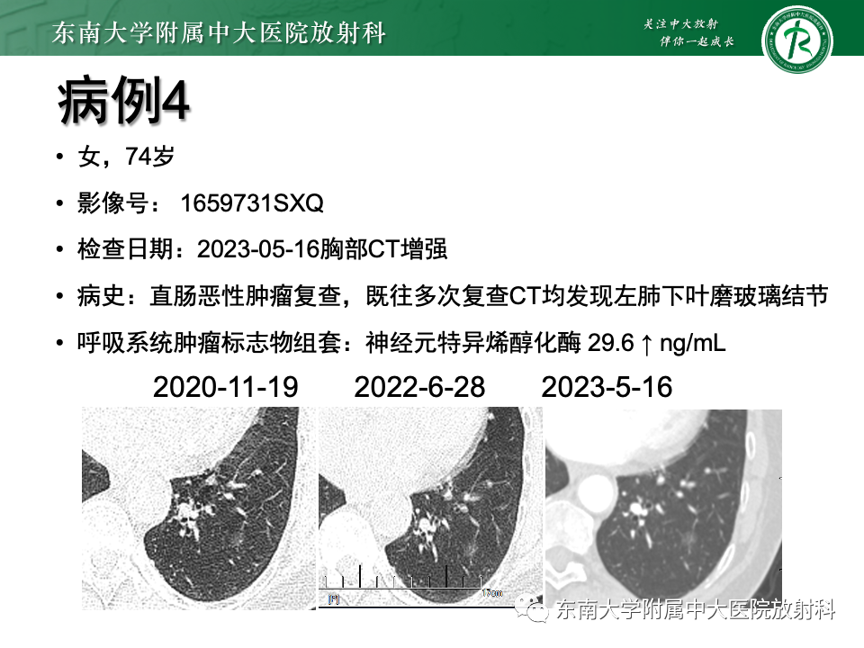 影像PPT - 【PPT】肺腺癌的CT影像表现-21 影像PPT - 【PPT】肺腺癌的CT影像表现-21
