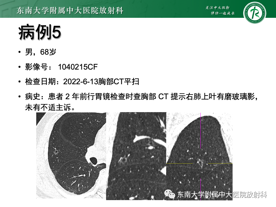 影像PPT - 【PPT】肺腺癌的CT影像表现-23 影像PPT - 【PPT】肺腺癌的CT影像表现-23