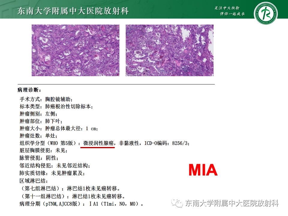 影像PPT - 【PPT】肺腺癌的CT影像表现-22 影像PPT - 【PPT】肺腺癌的CT影像表现-22