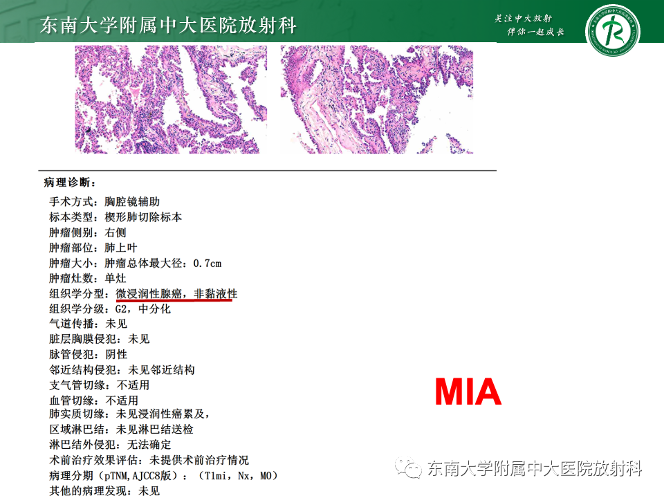 影像PPT - 【PPT】肺腺癌的CT影像表现-24 影像PPT - 【PPT】肺腺癌的CT影像表现-24