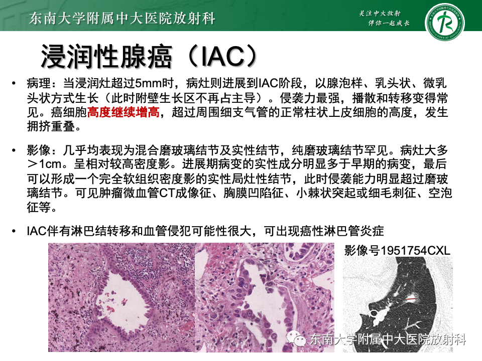影像PPT - 【PPT】肺腺癌的CT影像表现-25 影像PPT - 【PPT】肺腺癌的CT影像表现-25