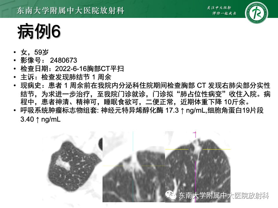 影像PPT - 【PPT】肺腺癌的CT影像表现-26 影像PPT - 【PPT】肺腺癌的CT影像表现-26
