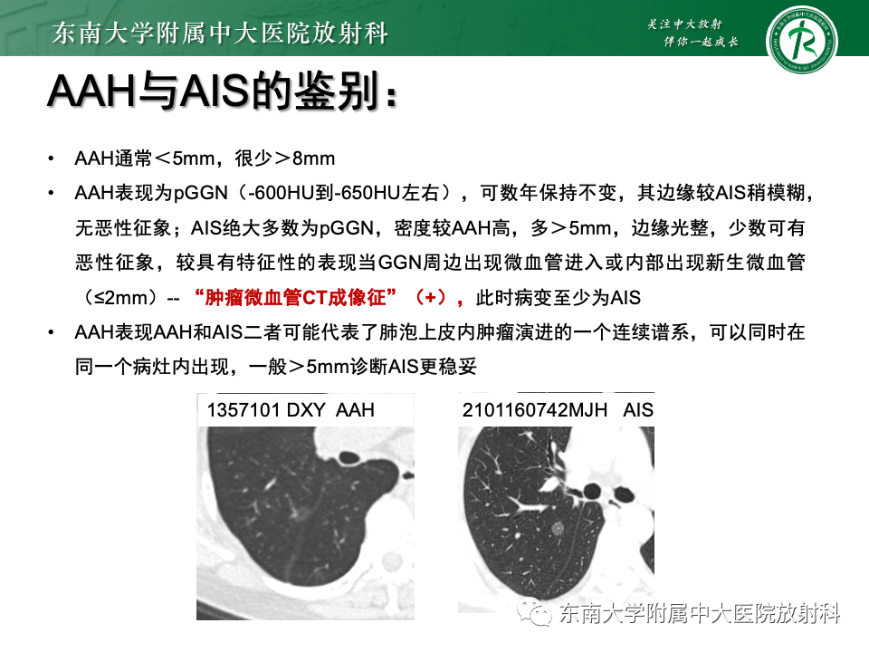 影像PPT - 【PPT】肺腺癌的CT影像表现-29 影像PPT - 【PPT】肺腺癌的CT影像表现-29