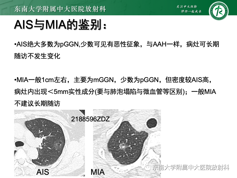 影像PPT - 【PPT】肺腺癌的CT影像表现-30 影像PPT - 【PPT】肺腺癌的CT影像表现-30