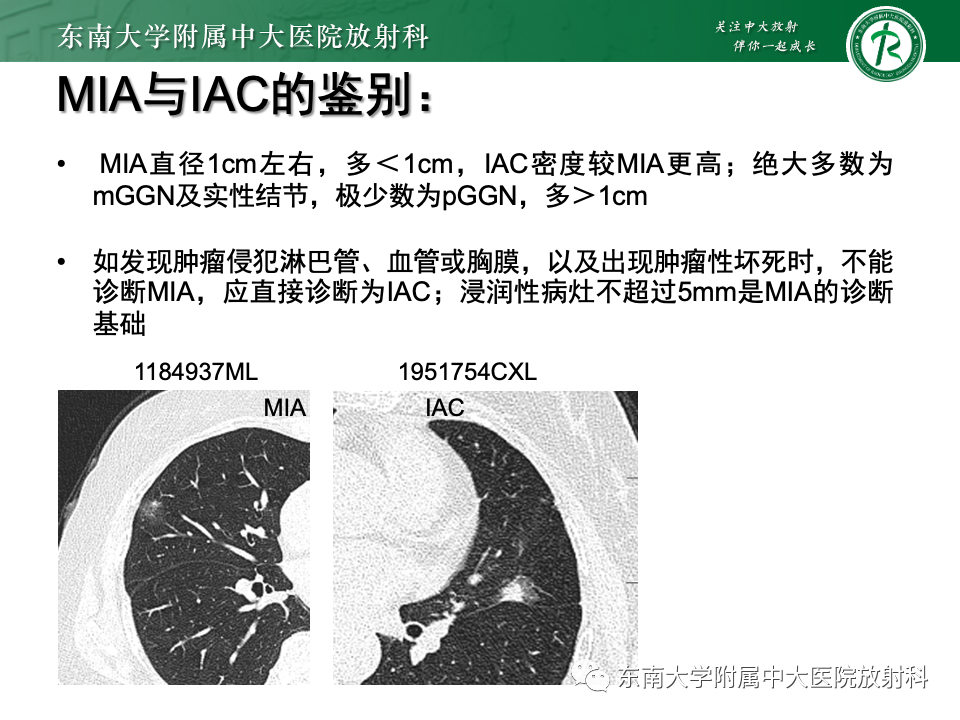影像PPT - 【PPT】肺腺癌的CT影像表现-31 影像PPT - 【PPT】肺腺癌的CT影像表现-31
