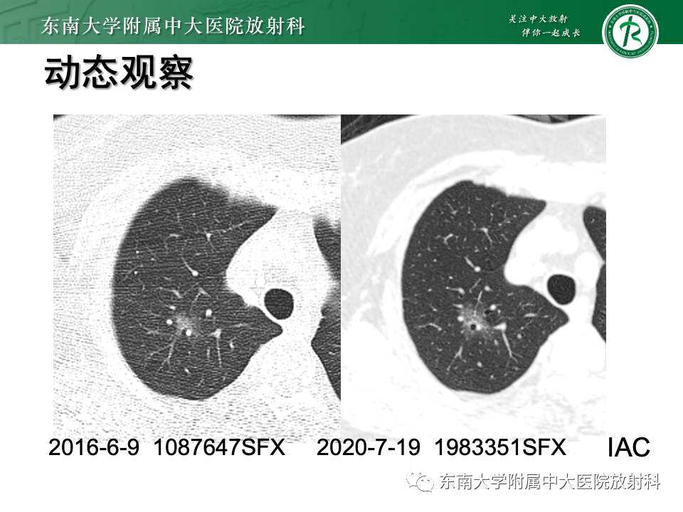 影像PPT - 【PPT】肺腺癌的CT影像表现-36 影像PPT - 【PPT】肺腺癌的CT影像表现-36