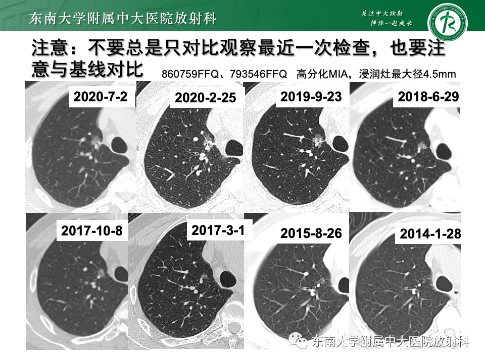 影像PPT - 【PPT】肺腺癌的CT影像表现-37 影像PPT - 【PPT】肺腺癌的CT影像表现-37