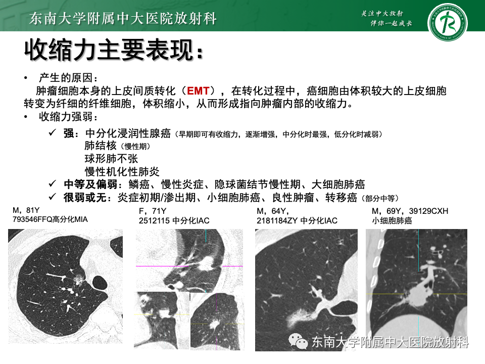 影像PPT - 【PPT】肺腺癌的CT影像表现-42 影像PPT - 【PPT】肺腺癌的CT影像表现-42