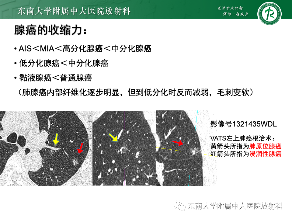 影像PPT - 【PPT】肺腺癌的CT影像表现-43 影像PPT - 【PPT】肺腺癌的CT影像表现-43