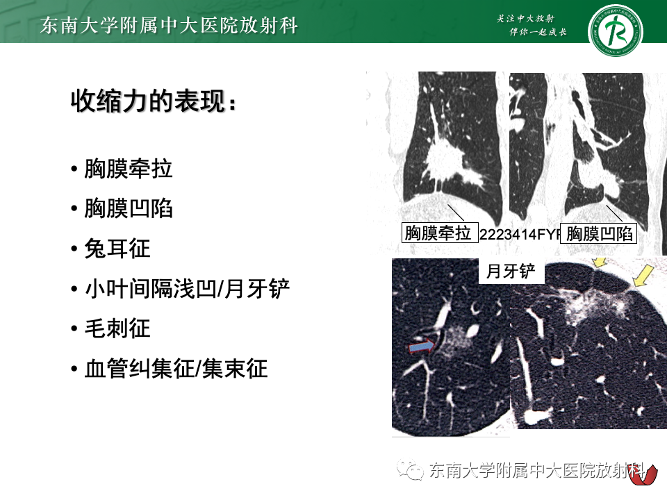 影像PPT - 【PPT】肺腺癌的CT影像表现-44 影像PPT - 【PPT】肺腺癌的CT影像表现-44
