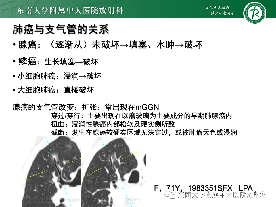 影像PPT - 【PPT】肺腺癌的CT影像表现-45 影像PPT - 【PPT】肺腺癌的CT影像表现-45