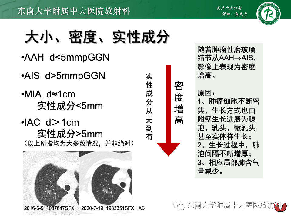 影像PPT - 【PPT】肺腺癌的CT影像表现-41 影像PPT - 【PPT】肺腺癌的CT影像表现-41