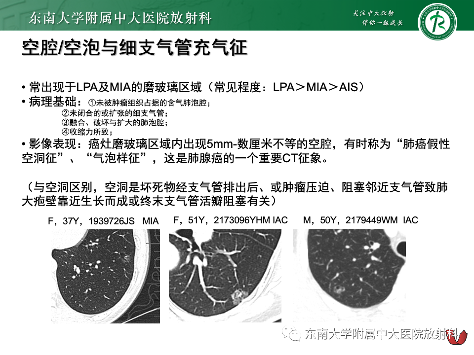影像PPT - 【PPT】肺腺癌的CT影像表现-46 影像PPT - 【PPT】肺腺癌的CT影像表现-46