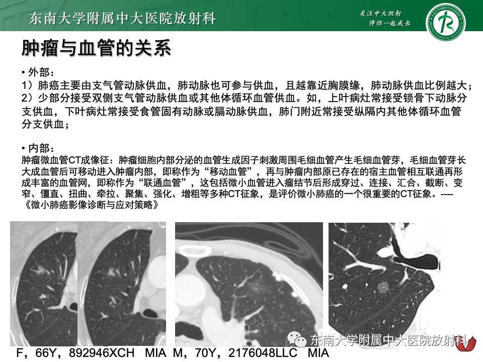 影像PPT - 【PPT】肺腺癌的CT影像表现-47 影像PPT - 【PPT】肺腺癌的CT影像表现-47