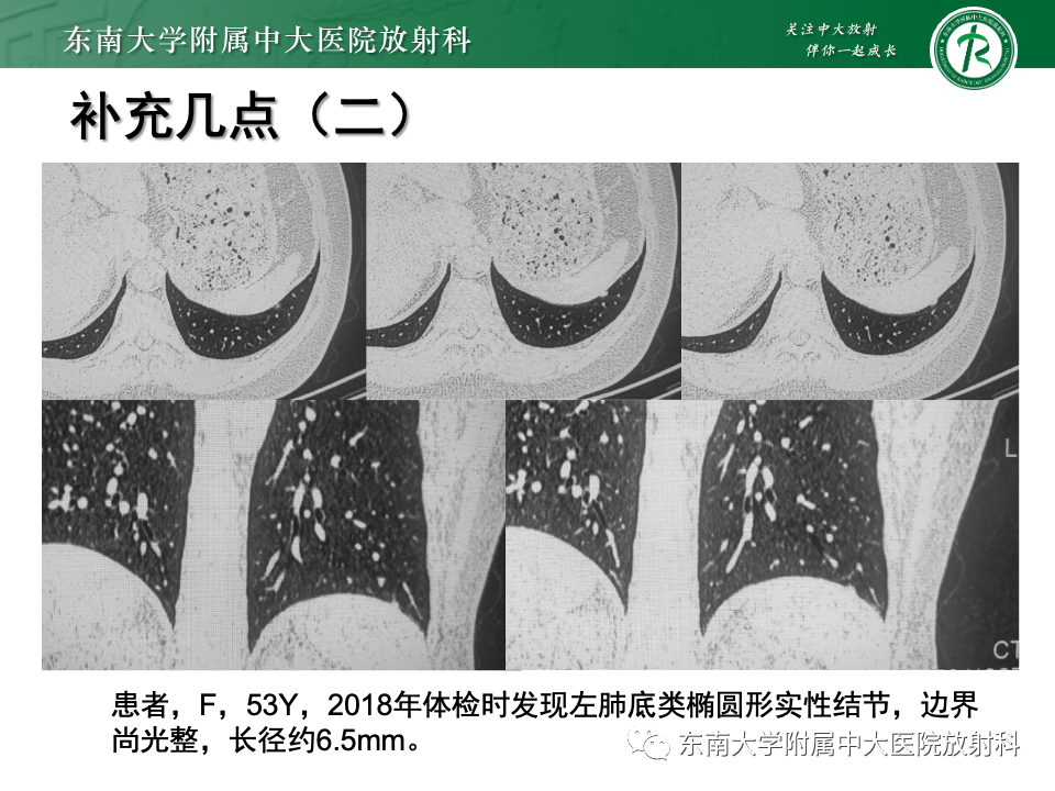 影像PPT - 【PPT】肺腺癌的CT影像表现-49 影像PPT - 【PPT】肺腺癌的CT影像表现-49