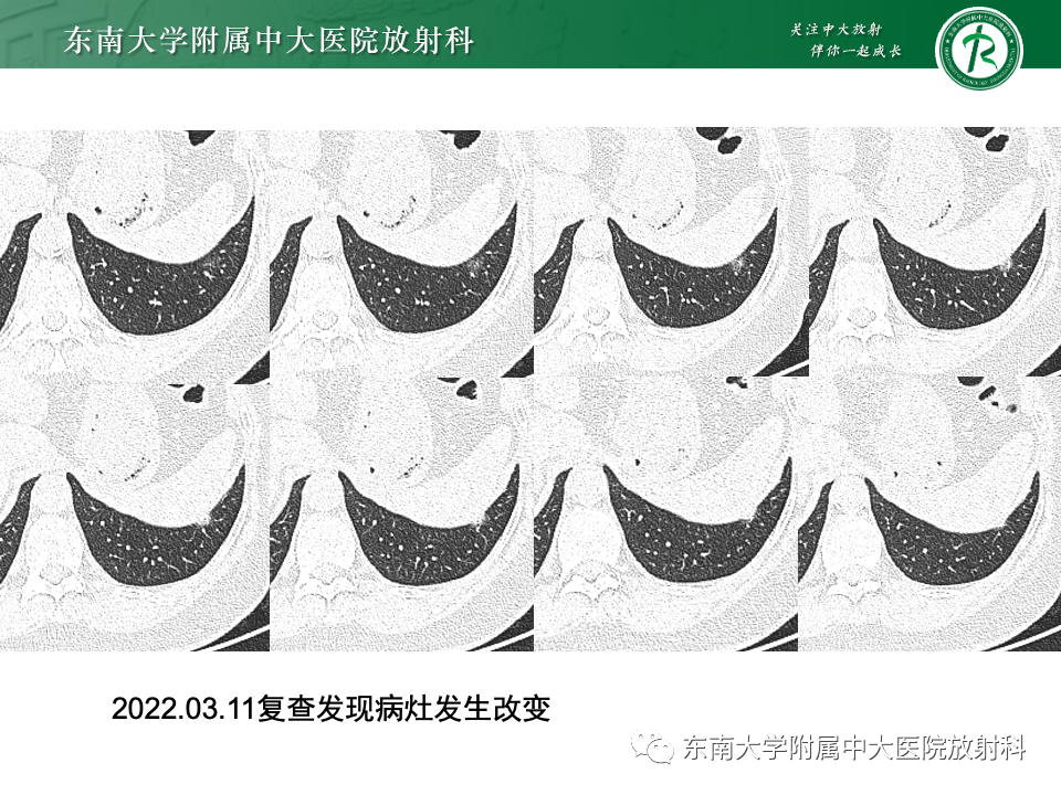 影像PPT - 【PPT】肺腺癌的CT影像表现-50 影像PPT - 【PPT】肺腺癌的CT影像表现-50