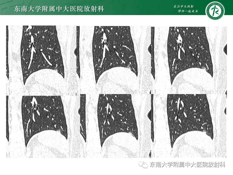 影像PPT - 【PPT】肺腺癌的CT影像表现-52 影像PPT - 【PPT】肺腺癌的CT影像表现-52