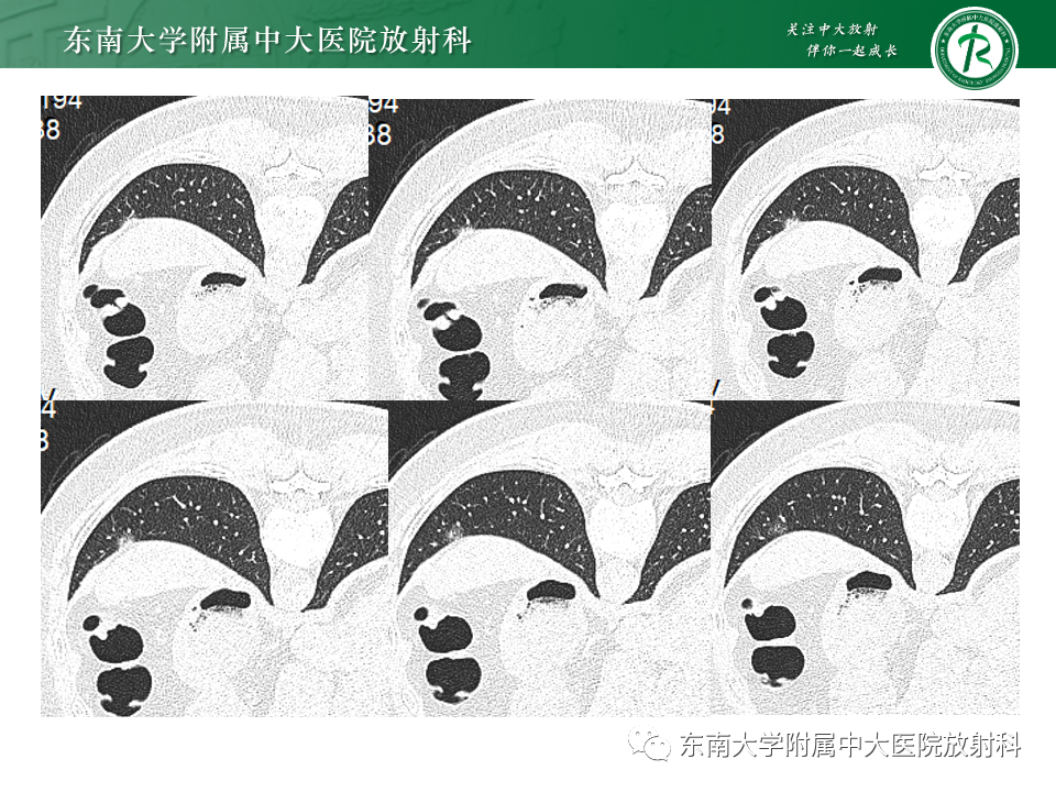 影像PPT - 【PPT】肺腺癌的CT影像表现-51 影像PPT - 【PPT】肺腺癌的CT影像表现-51