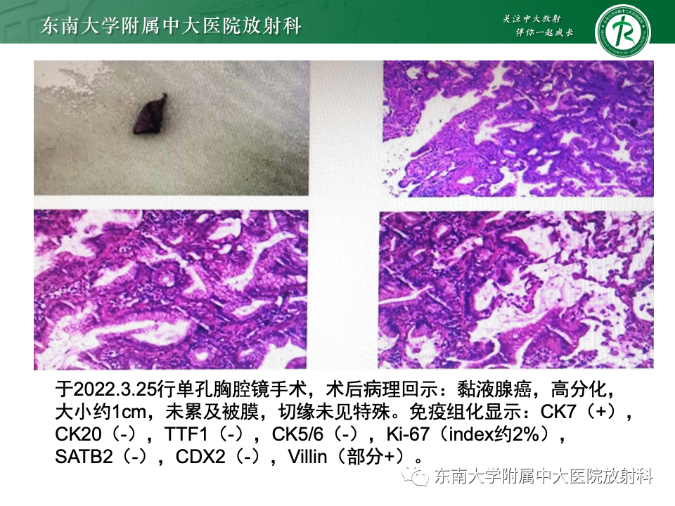 影像PPT - 【PPT】肺腺癌的CT影像表现-53 影像PPT - 【PPT】肺腺癌的CT影像表现-53