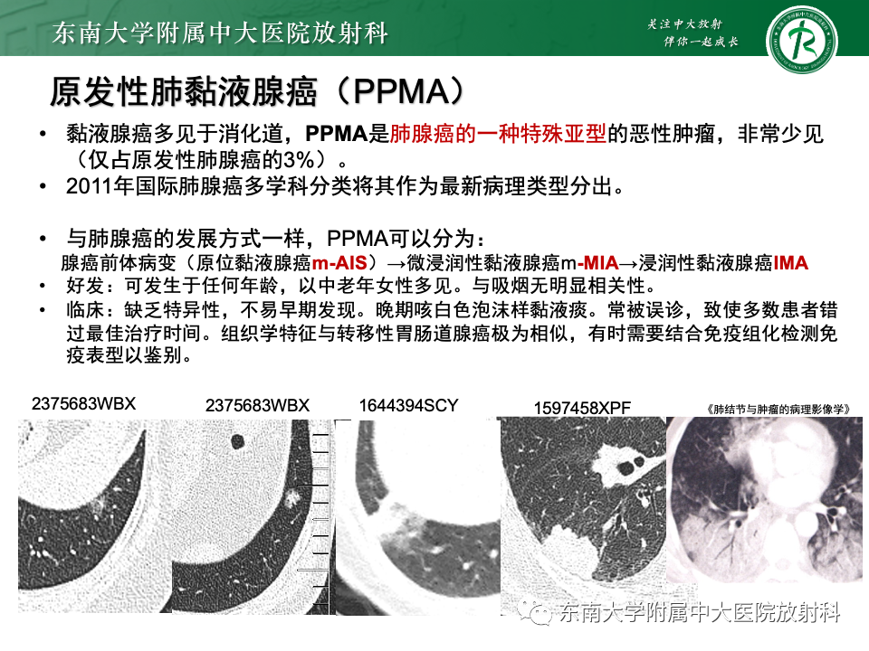 影像PPT - 【PPT】肺腺癌的CT影像表现-55 影像PPT - 【PPT】肺腺癌的CT影像表现-55