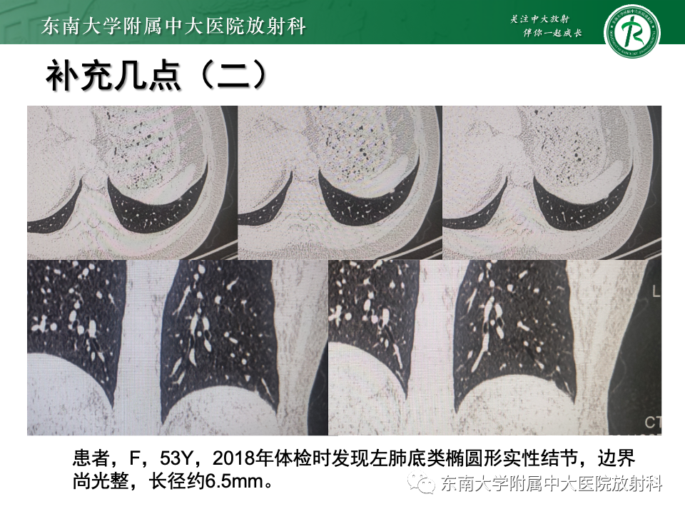 影像PPT - 【PPT】肺腺癌的CT影像表现-54 影像PPT - 【PPT】肺腺癌的CT影像表现-54