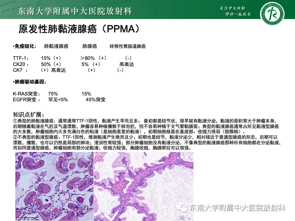 影像PPT - 【PPT】肺腺癌的CT影像表现-56 影像PPT - 【PPT】肺腺癌的CT影像表现-56