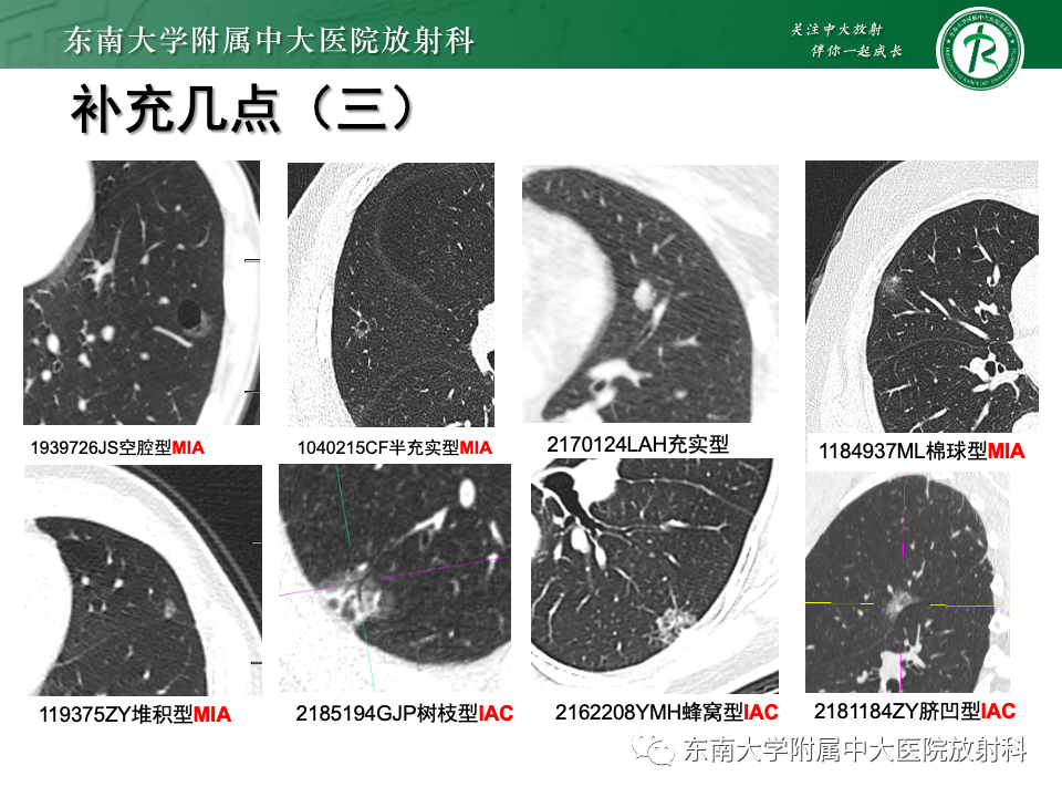 影像PPT - 【PPT】肺腺癌的CT影像表现-59 影像PPT - 【PPT】肺腺癌的CT影像表现-59