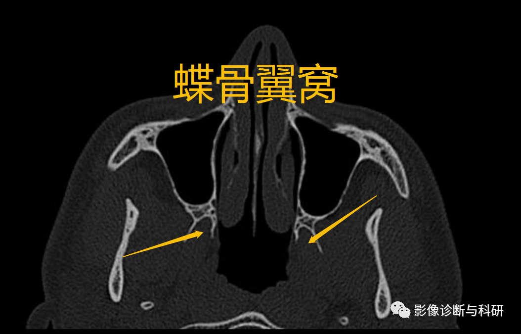 影像PPT - 翼窝、颞窝、颞下窝、翼腭窝CT解剖-2 影像PPT - 翼窝、颞窝、颞下窝、翼腭窝CT解剖-2
