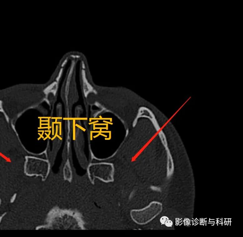 影像PPT - 翼窝、颞窝、颞下窝、翼腭窝CT解剖-6 影像PPT - 翼窝、颞窝、颞下窝、翼腭窝CT解剖-6