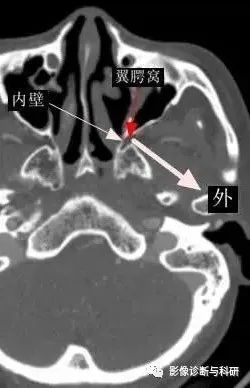 影像PPT - 翼窝、颞窝、颞下窝、翼腭窝CT解剖-14 影像PPT - 翼窝、颞窝、颞下窝、翼腭窝CT解剖-14