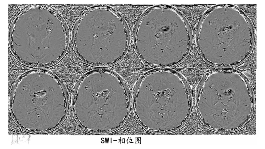 影像PPT - 【病例】弥漫性半球胶质瘤(H3G34突变型)1例MR影像-9